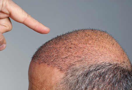 Hair Transplant Scar: Is It For Lifetime Or Only Temporary? | Longevita Hair  Transplant