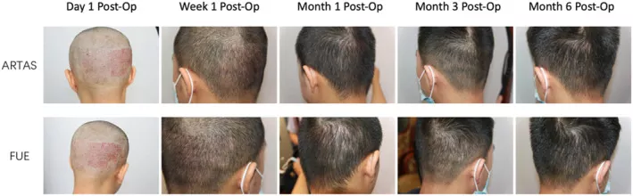 robotic hair transplant 1