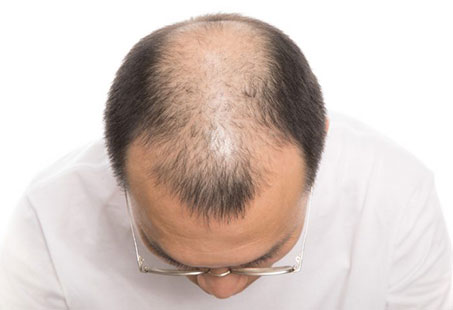 alternative solutions to hair loss