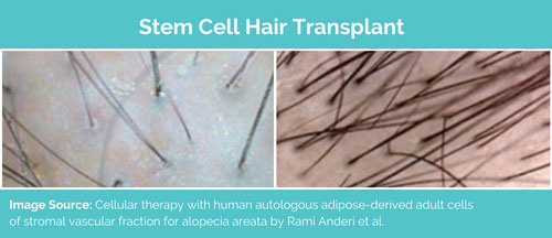 Stem Cell Hair Transplant Result