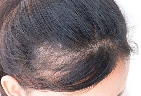 PCOS Hair Loss: Causes & 8 Effective Treatment Options