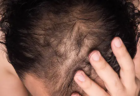 Does Hair Transplant Damage Existing Hair?