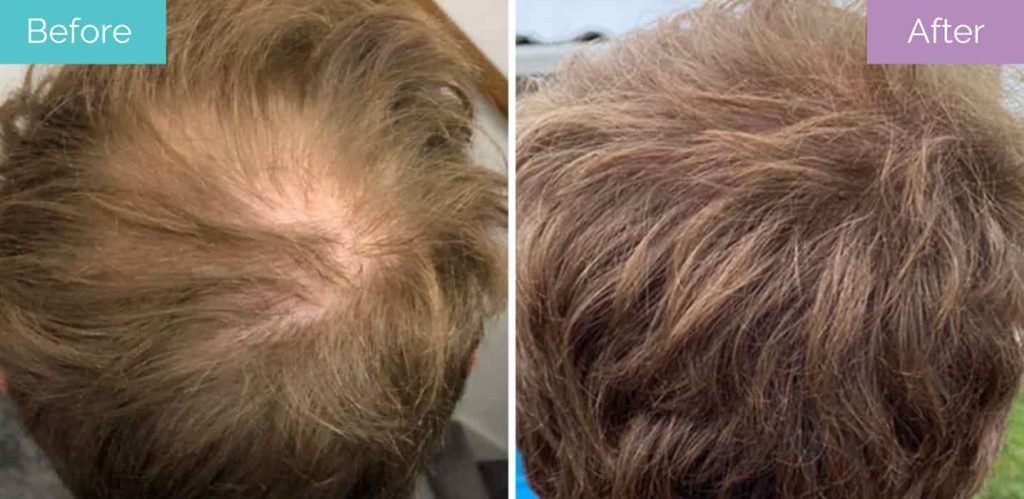 Crown Hair Transplant: Procedure, Recovery, & Success Rate | Longevita