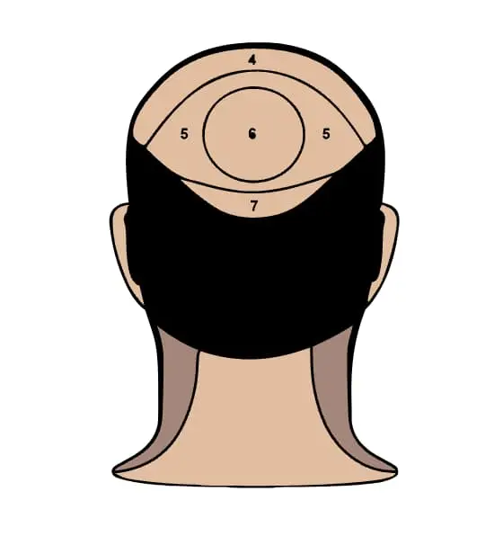 Crown hair transplant zones