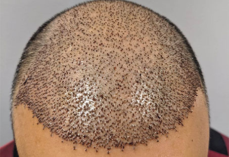 Hair Transplant Scabs: Should You Worry About Them? | Longevita
