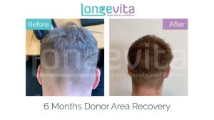 6 months donor area