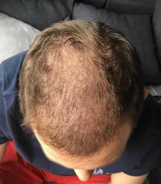 Hair transplant shock loss
