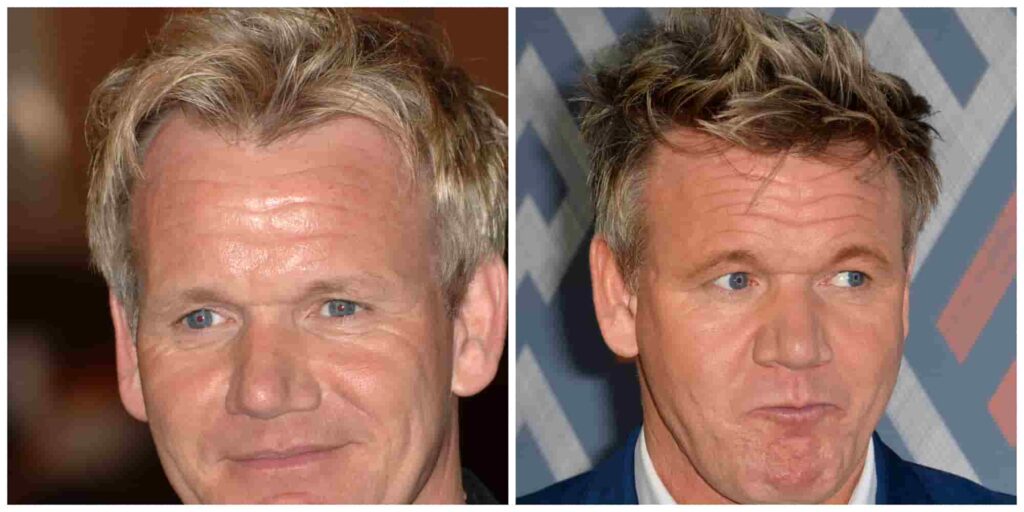 Gordon Ramsay before and after alleged hair transplant