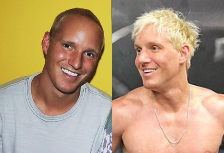 jamie laing before and after hair transplant