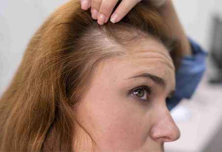 dry scalp hair loss