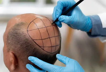 Mega Session Of A Hair Transplant: Is It Better?