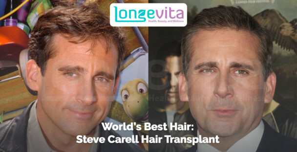 side-by-side images of Steve Carell before and after hair transplant with headline praising his hair