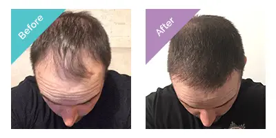 top view comparison of male patient before with thinning hairline and after with thicker hair following transplant