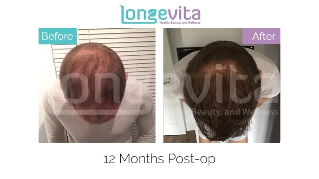 Body Hair Transplant | Why It Yields Poor Results | Longevita