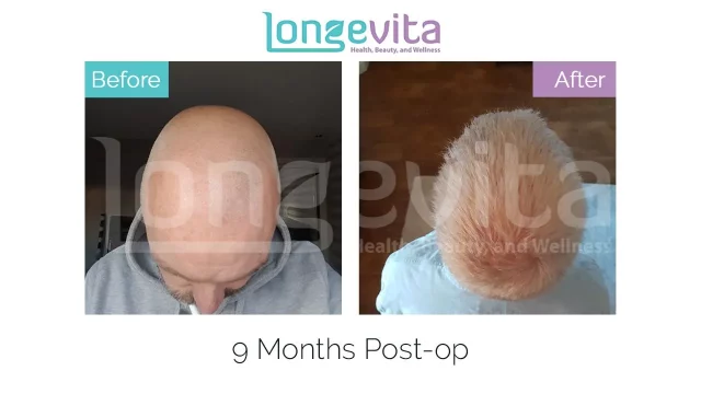 Body Hair Transplant | Why It Yields Poor Results | Longevita