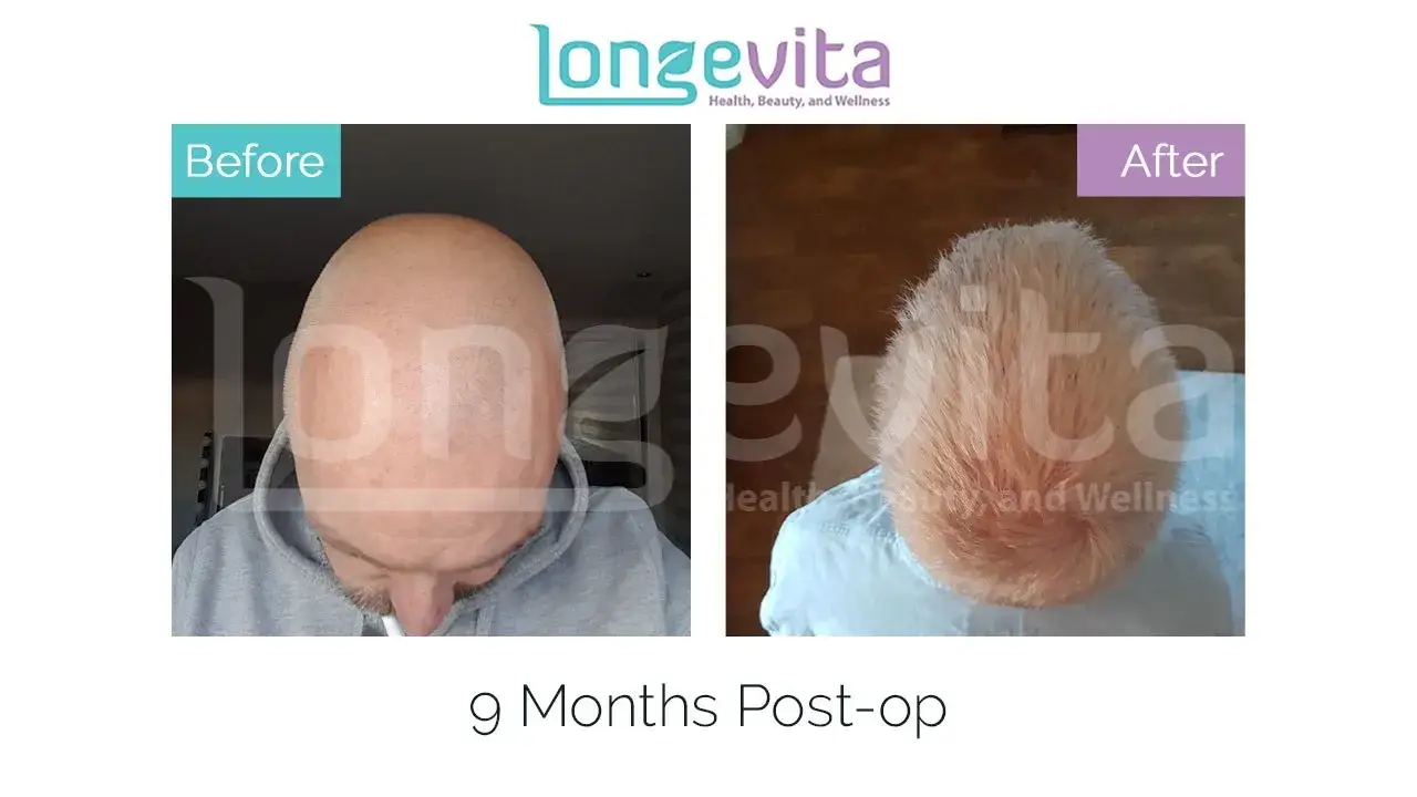 Two side-by-side photos labeled "Before" and "After" display a person's head top, showing hair regrowth progress labeled "9 Months Post-op" for a company named "Longevita."