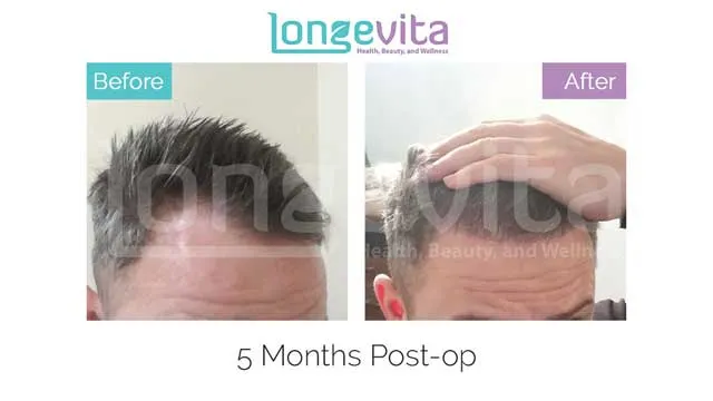 Hair Transplant Before And After Photos | Longevita