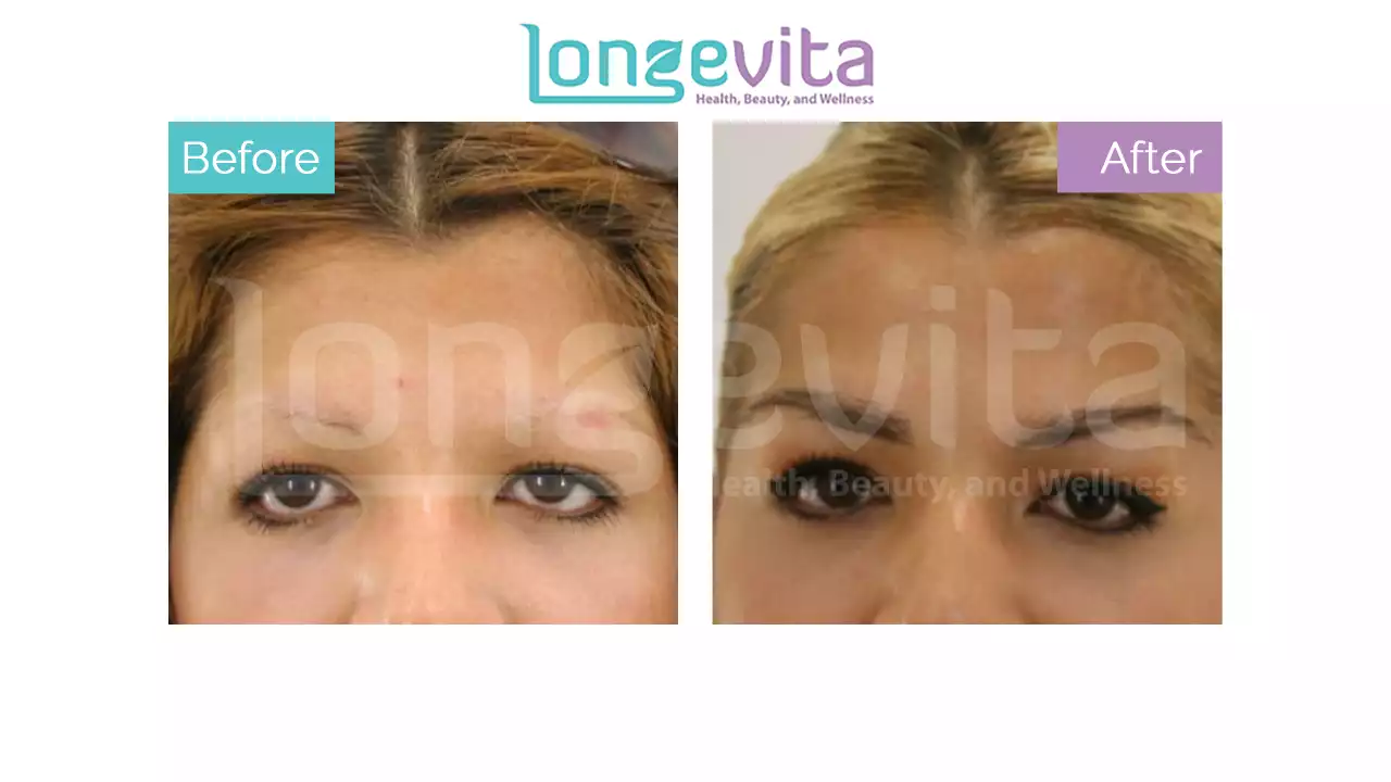 Eyebrow Transplant | Thicker Brows | Lifetime Results | Longevita