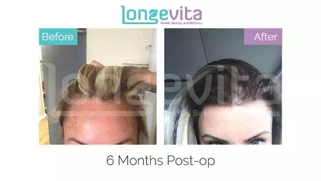 Female Hair Transplant In Turkey | Longevita
