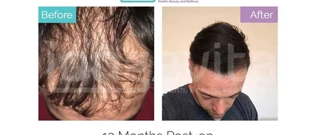 hair transplant turkey before after 15