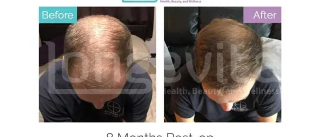 Hair Transplant Before And After Photos | Longevita
