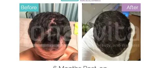 hair transplant turkey before after 8