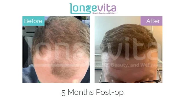 ICE Graft Hair Transplant | Ensure High Graft Survival | Longevita