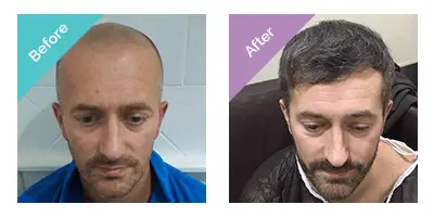 side-by-side comparison showing male patient before with bald head and after with full hair growth following transplant