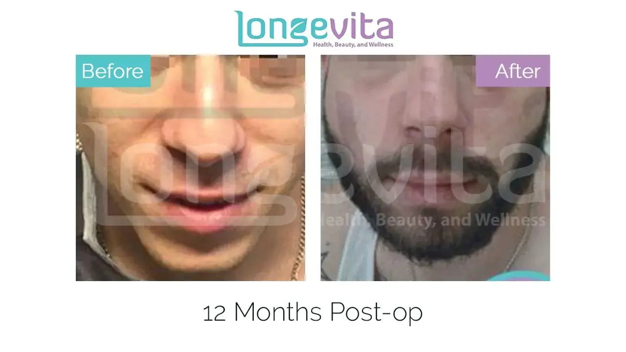 moustache hair transplant
