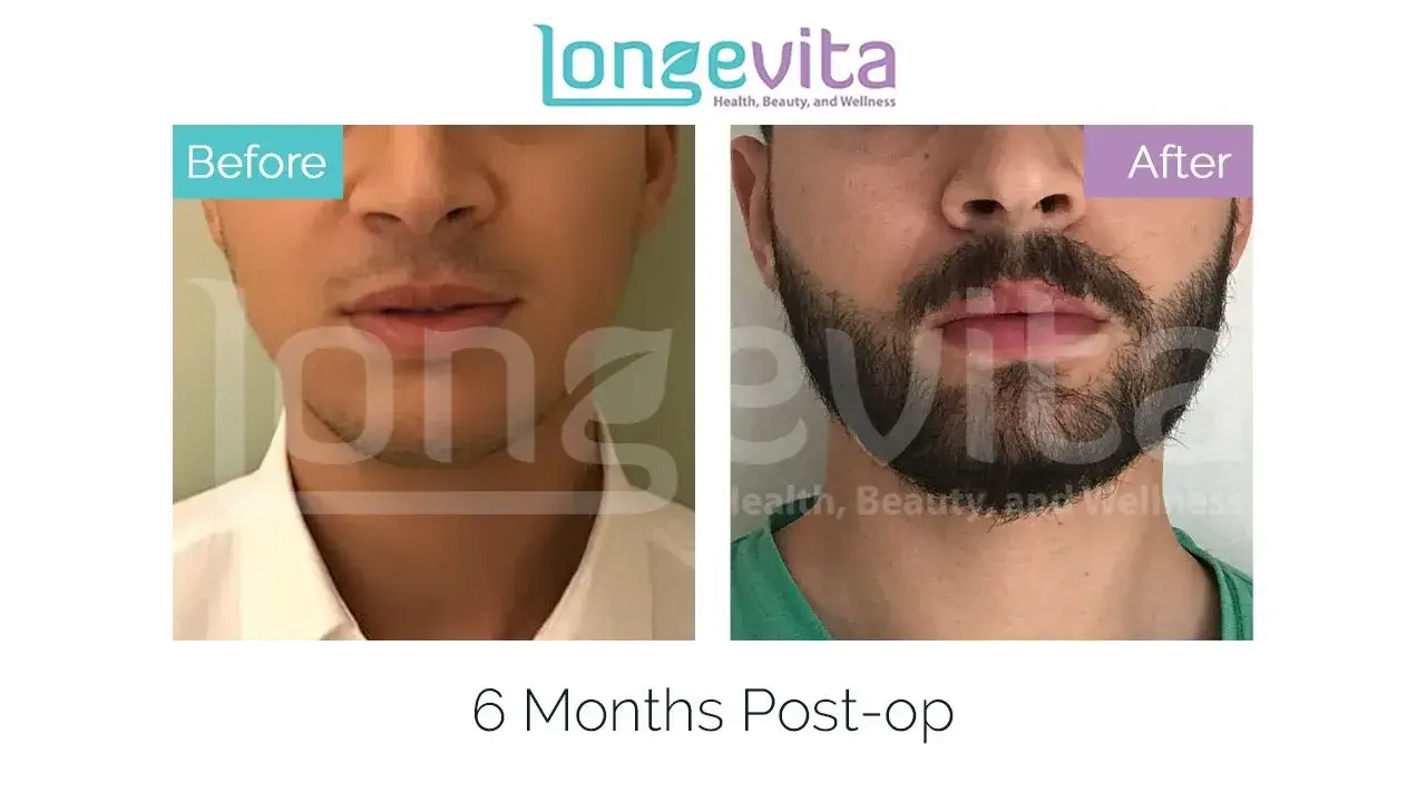 moustache transplant turkey