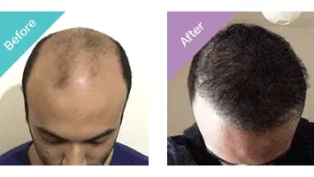PRP Injection | Stimulate Hair Growth | Longevita