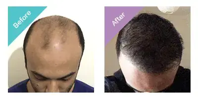 top view comparison showing male patient before with severe hair thinning and after with dense hair growth post transplant