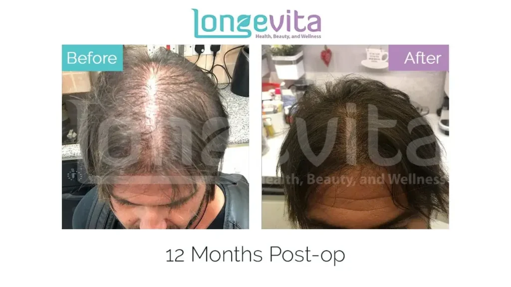 unshaven hair transplant