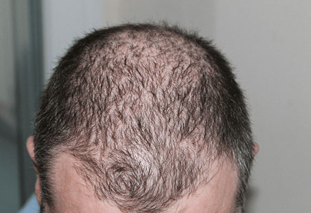 hair transplant recovery