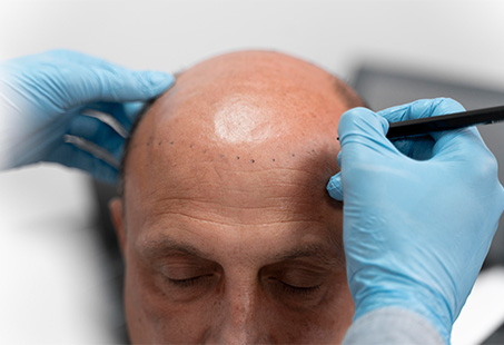 13 Side Effects Of Hair Transplant You Need To Know About