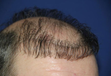Hair Transplant Gone Wrong: Signs, Causes & Solutions | Longevita