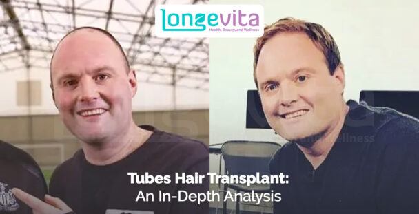 before-and-after photos of Tubes showing hair restoration results