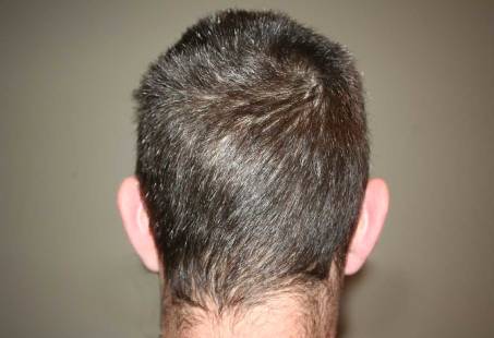 Cowlick: Is It A Sign Of Balding? | Longevita