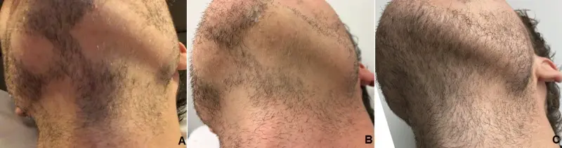 Alopecia Barbae 2