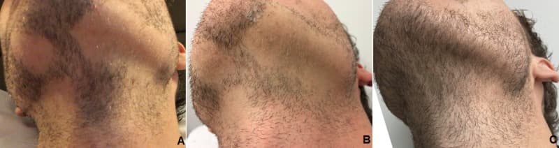 hair loss in beard