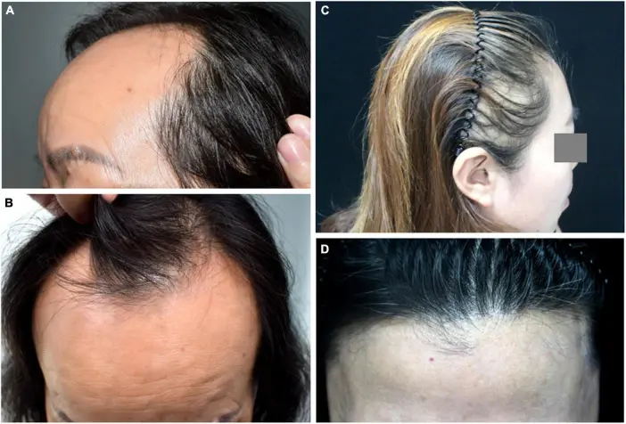 frontal fibrosing alopecia