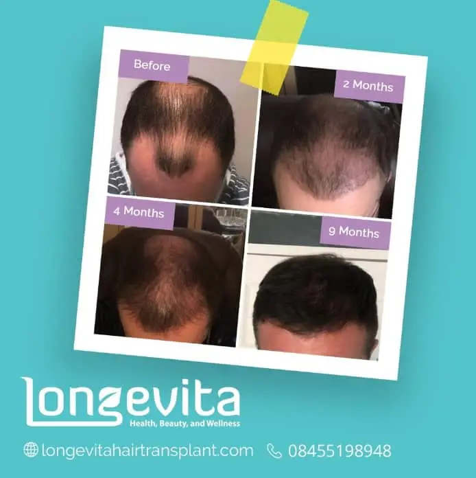 9 months after hair transplant