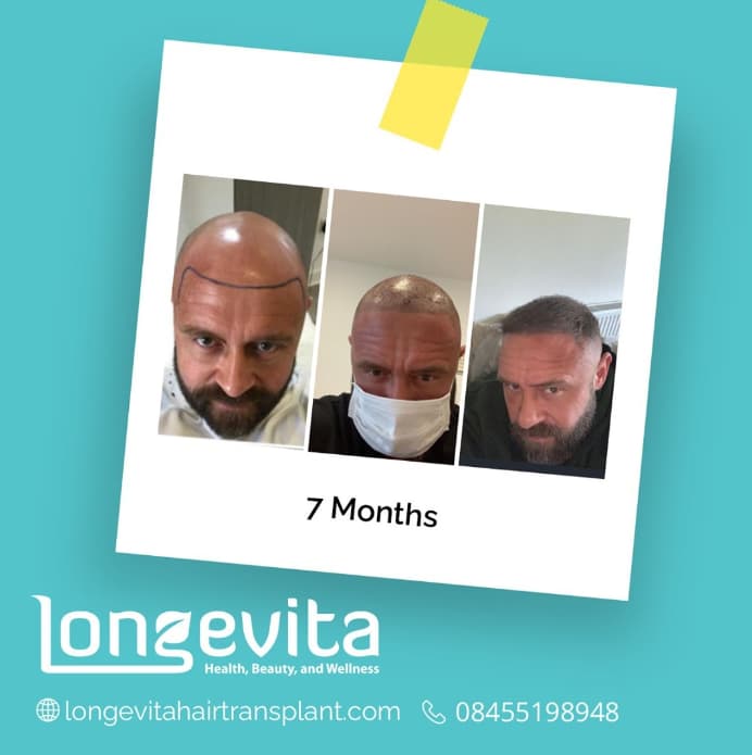 7 months after hair transplant