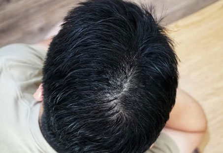 oily scalp after hair transplant