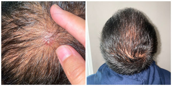 Pimples After Hair Transplant: Are They Normal? | Longevita