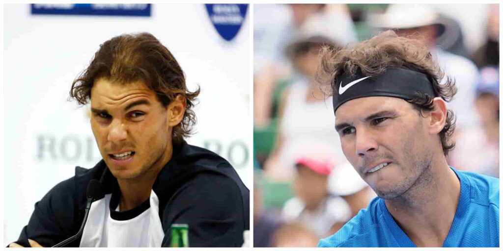 Rafael Nadal before and after alleged hair transplant