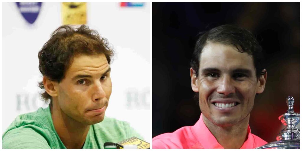 Rafael Nada's hair before and after