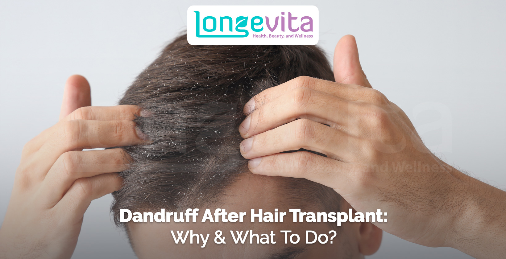 close-up of a man parting his hair with visible dandruff flakes on scalp after hair transplant