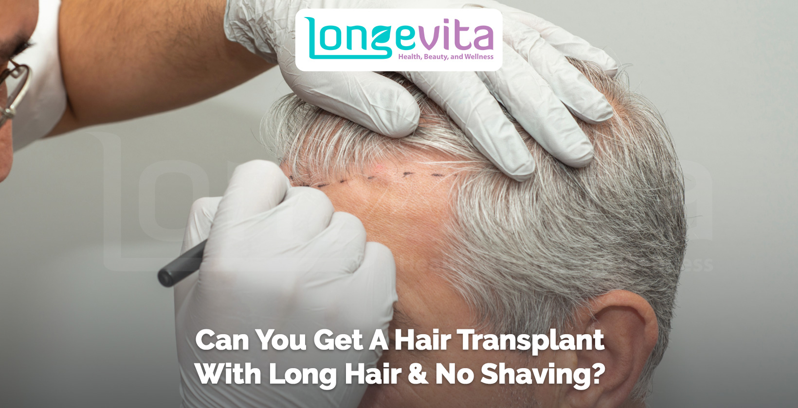 doctor performing a hair transplant on a man with longer hair without shaving the scalp