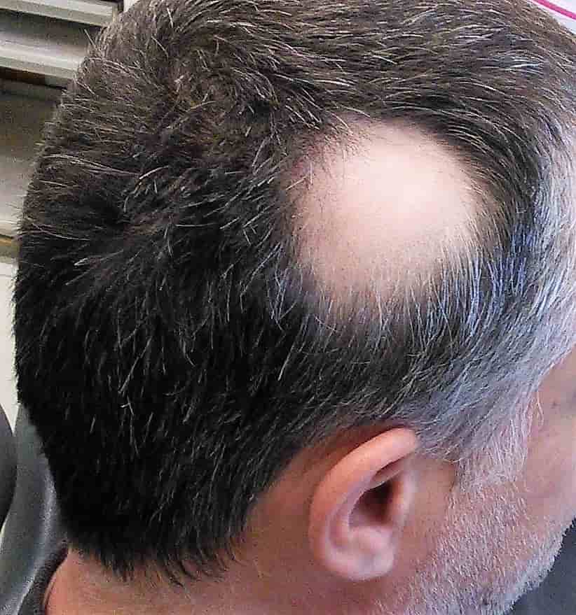 Alopecia areata hair loss